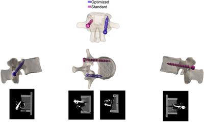Bone density optimized pedicle screw insertion